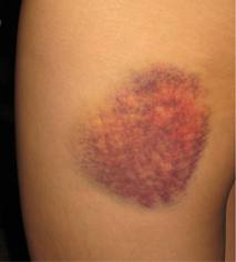 A bruise
